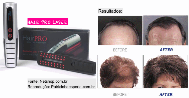 Hair Pro Laser resultados