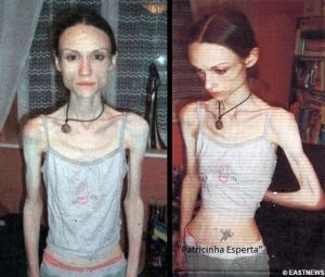 anorexia1 300x255 - Anorexia Nervosa