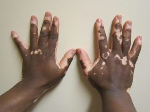 vitiligo 620 300x225 - Doença marcada pelo preconceito