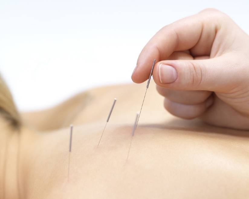 acupuntura SN - Acupuntura Serve Para Quê?