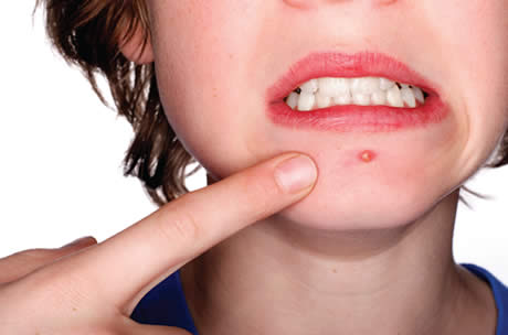 acne - Acne Adulta: O Tormento!