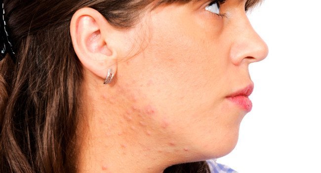 doenca pele emocional 650x350 - Como O Estresse se Manifesta na Pele?