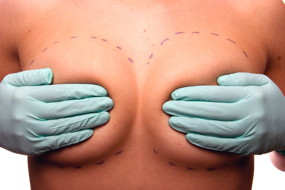 mamoplastia