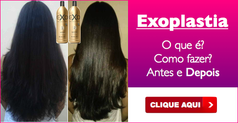 Acne In Hair >> Exoplastia Exo Hair: Como usar e Antes e Depois! (outubro 2019) Acne In Hair >> Exoplastia Exo Hair: Como usar e Antes e Depois! (outubro 2019)